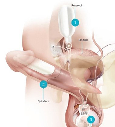 Penile Implant Surgery