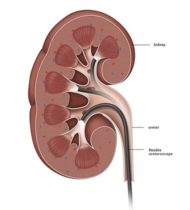 RIRS Surgery in Lucknow